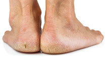 脚后跟容易干裂是什么原因导致的？会有什么后果？
