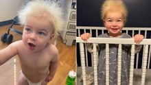 爱因斯坦同款发型！美国男婴患罕见难梳头发综合征